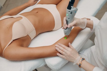 épilation laser